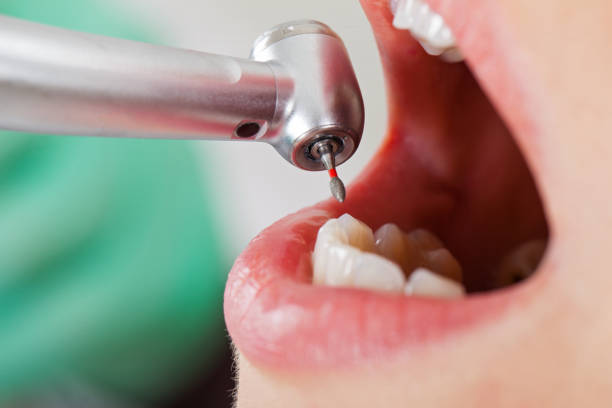 Best Dentist for Tooth Abscess  in Mlstadt, IL